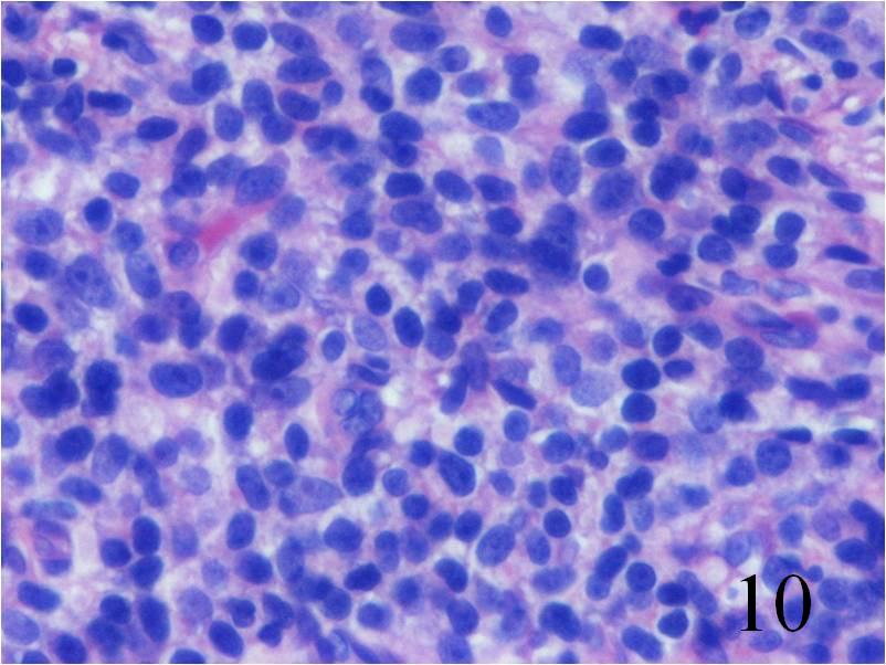Tumor Surgery : Bone Cancer Tumors : Sarcoma Surgeon : NYC